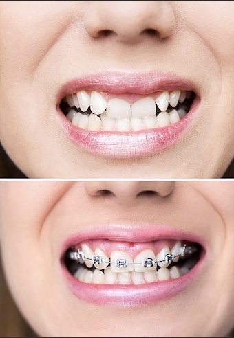 Braces Before and After