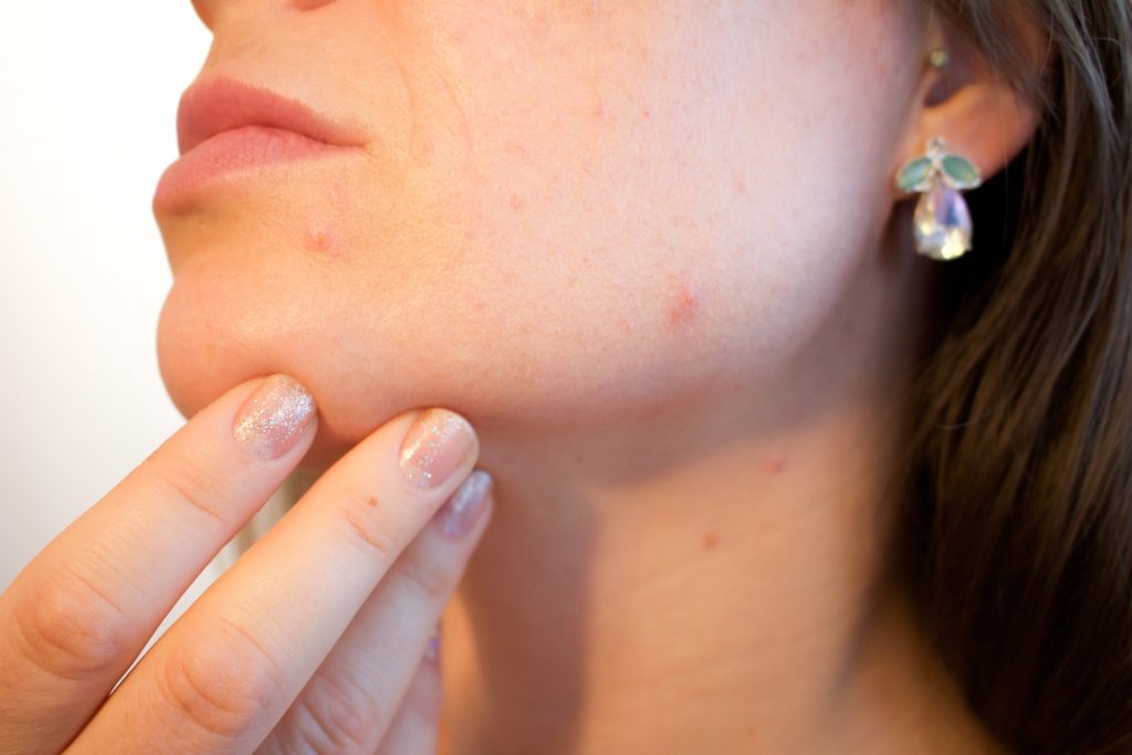 how to get rid of blemishes