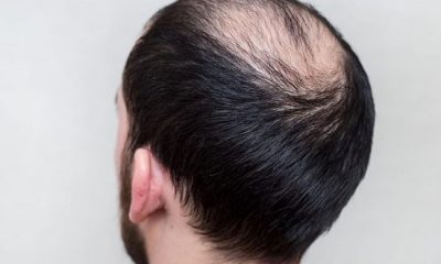 What Are the Main Types of Baldness