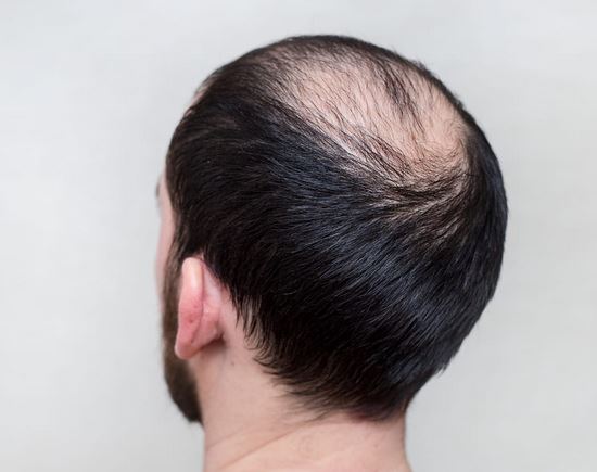 What Are the Main Types of Baldness