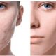 LASER TREATMENT FOR ACNE SCARS
