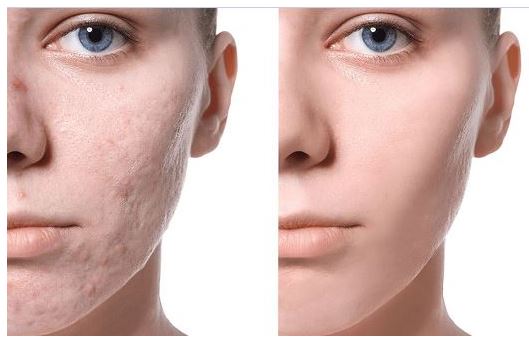 LASER TREATMENT FOR ACNE SCARS