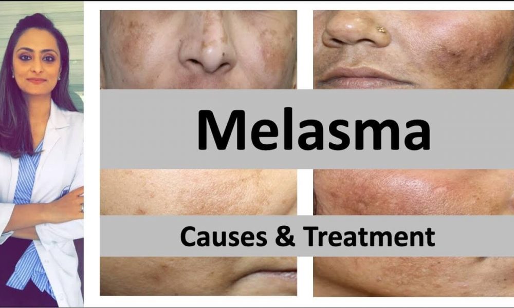 Treatment to Get Rid of Melasma