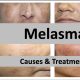 Treatment to Get Rid of Melasma