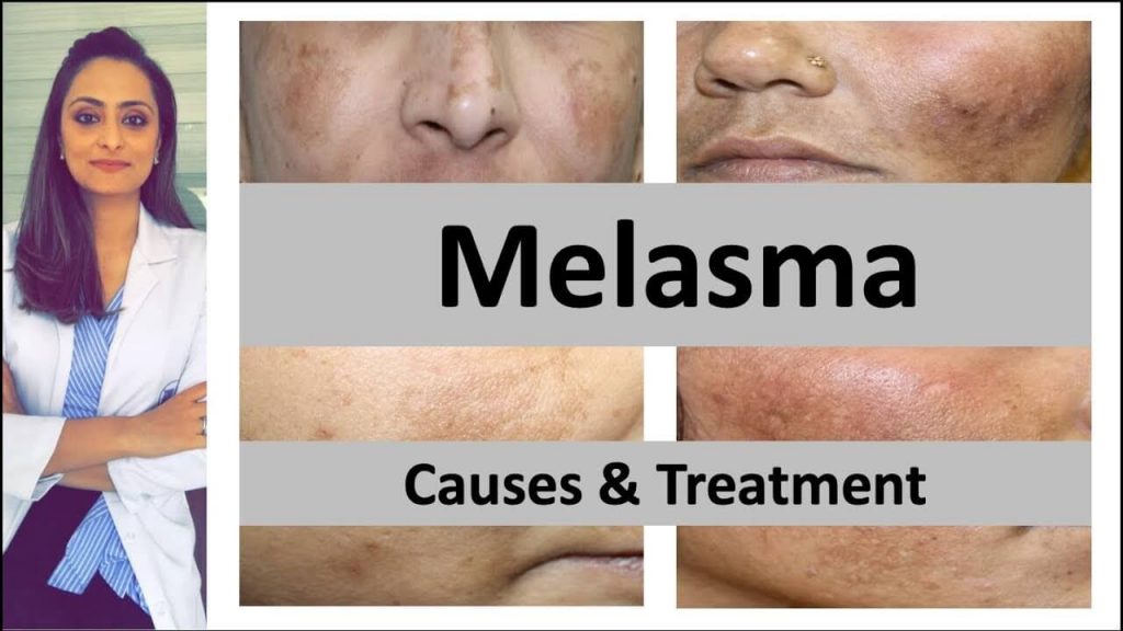 Treatment to Get Rid of Melasma