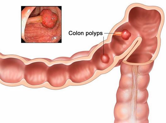 How Can We Detect Colon Cancer Early