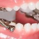 Five Tips for Cleaning Dental Appliances