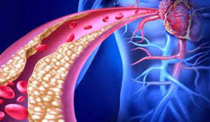 Hypercholesterolemia