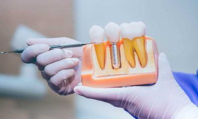 The Benefits of Dental Implants