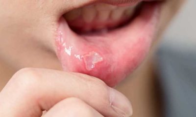 Can Certain Kinds Of Toothpaste Cause Canker Sores