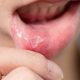 Can Certain Kinds Of Toothpaste Cause Canker Sores