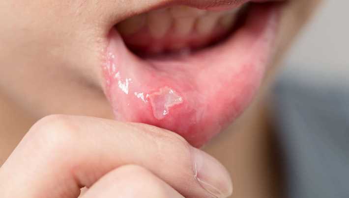 Can Certain Kinds Of Toothpaste Cause Canker Sores