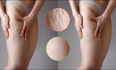 Are there any effective topical treatments for cellulite?