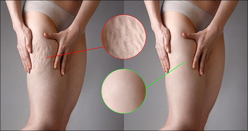 Are there any effective topical treatments for cellulite?